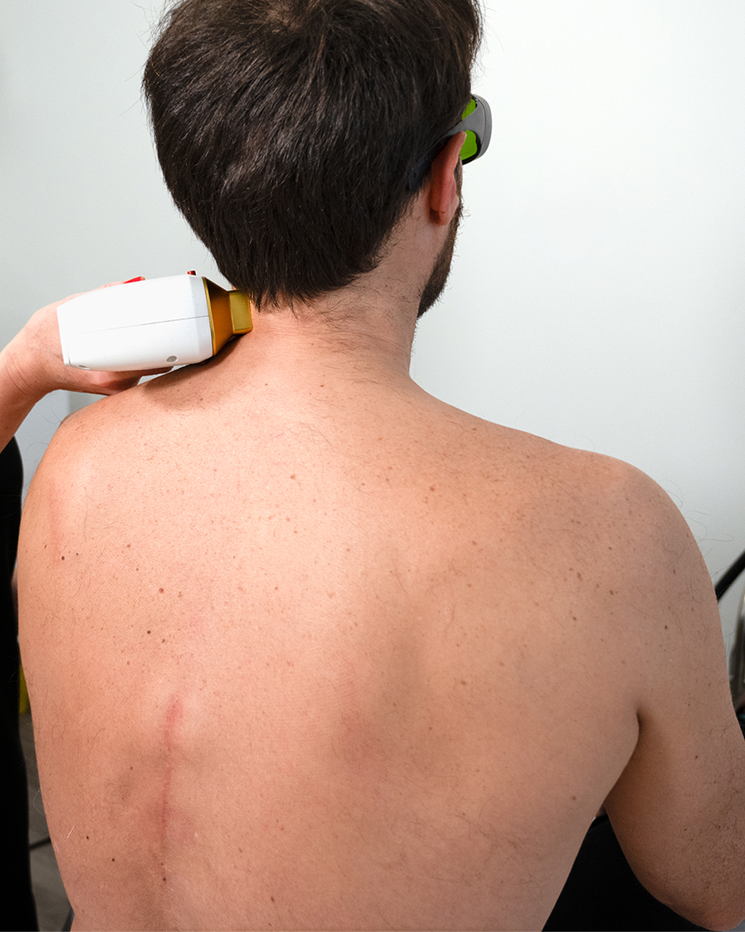 Épilation laser homme