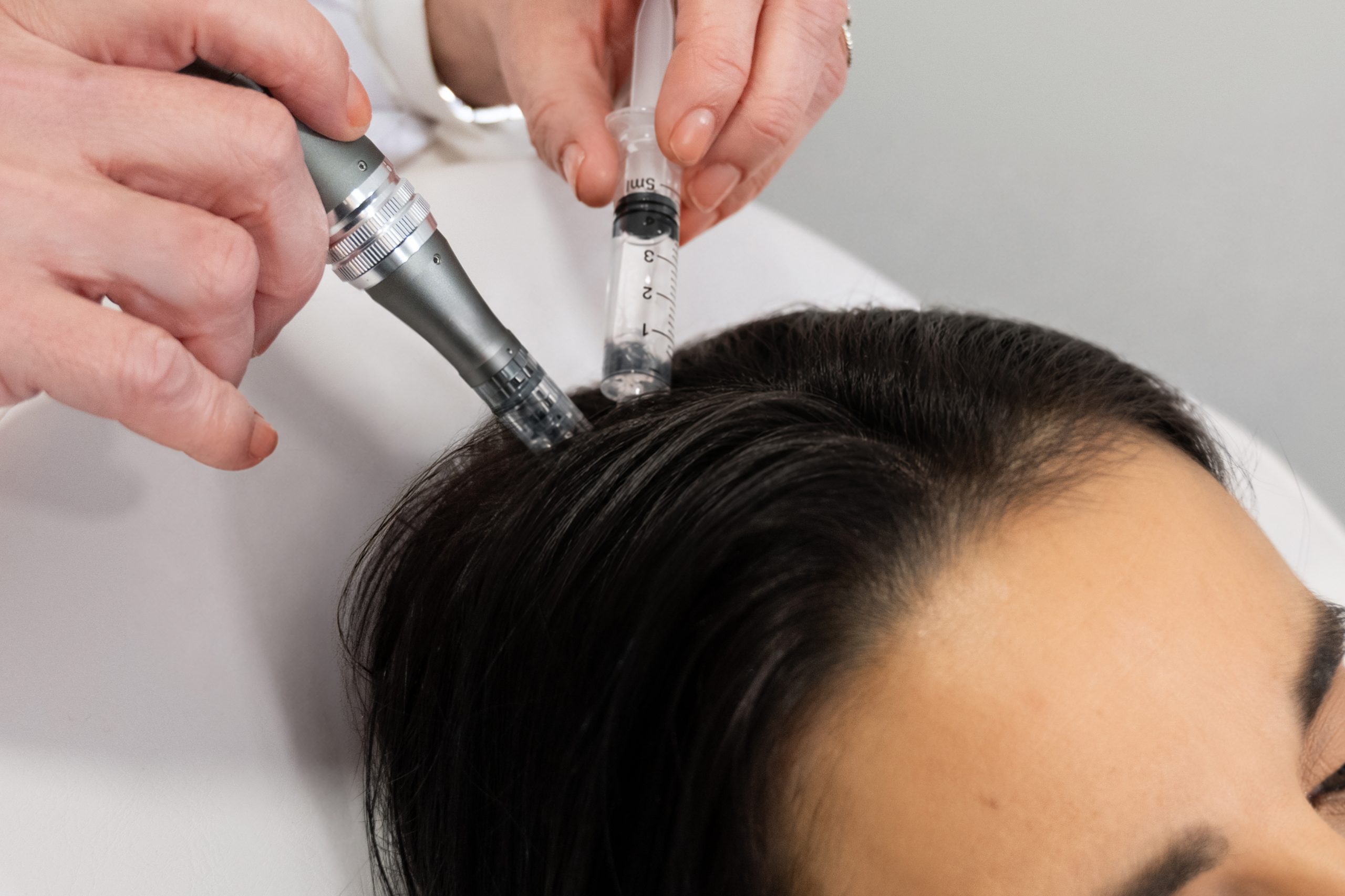 Traitement cuir chevelu anti-chute de cheveux au cabinet Laser Saint Caprais