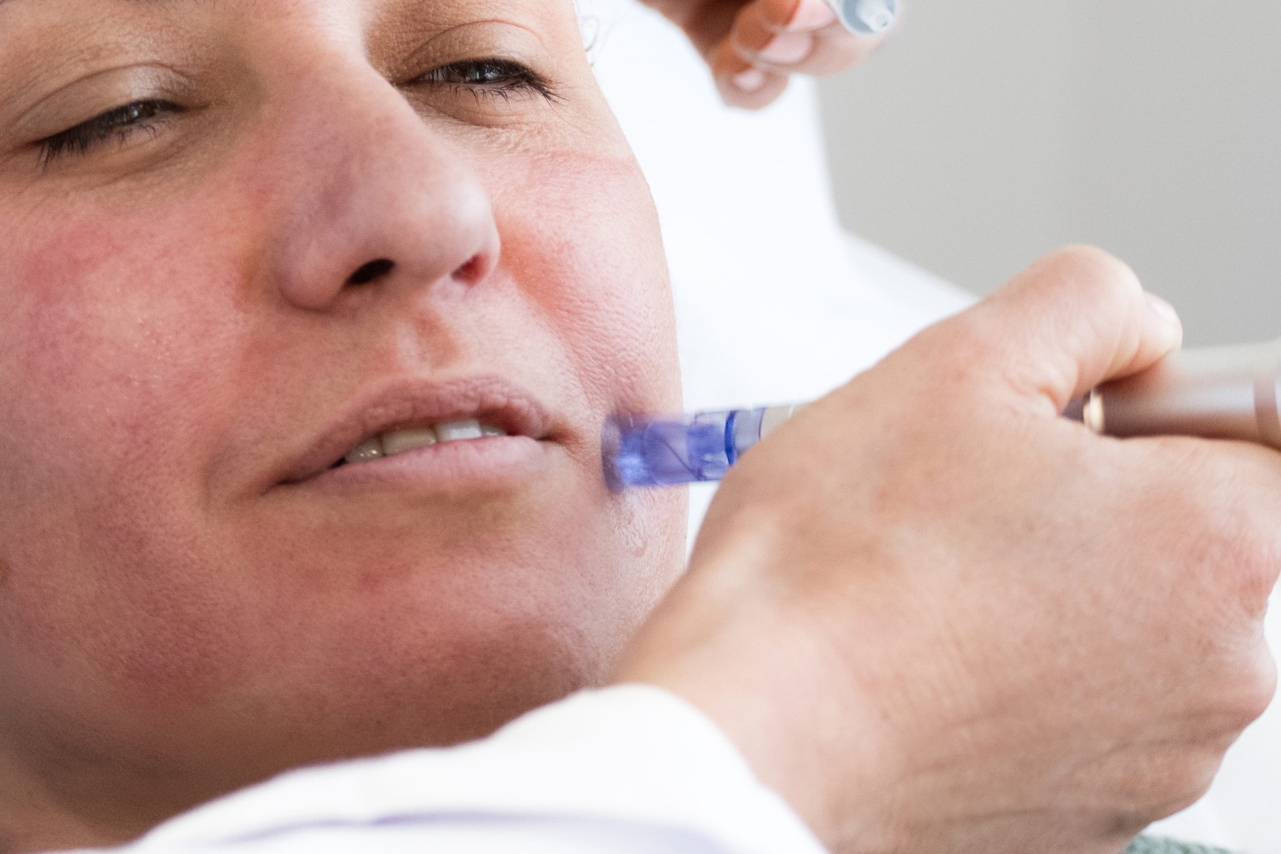 Soin microneedling visage