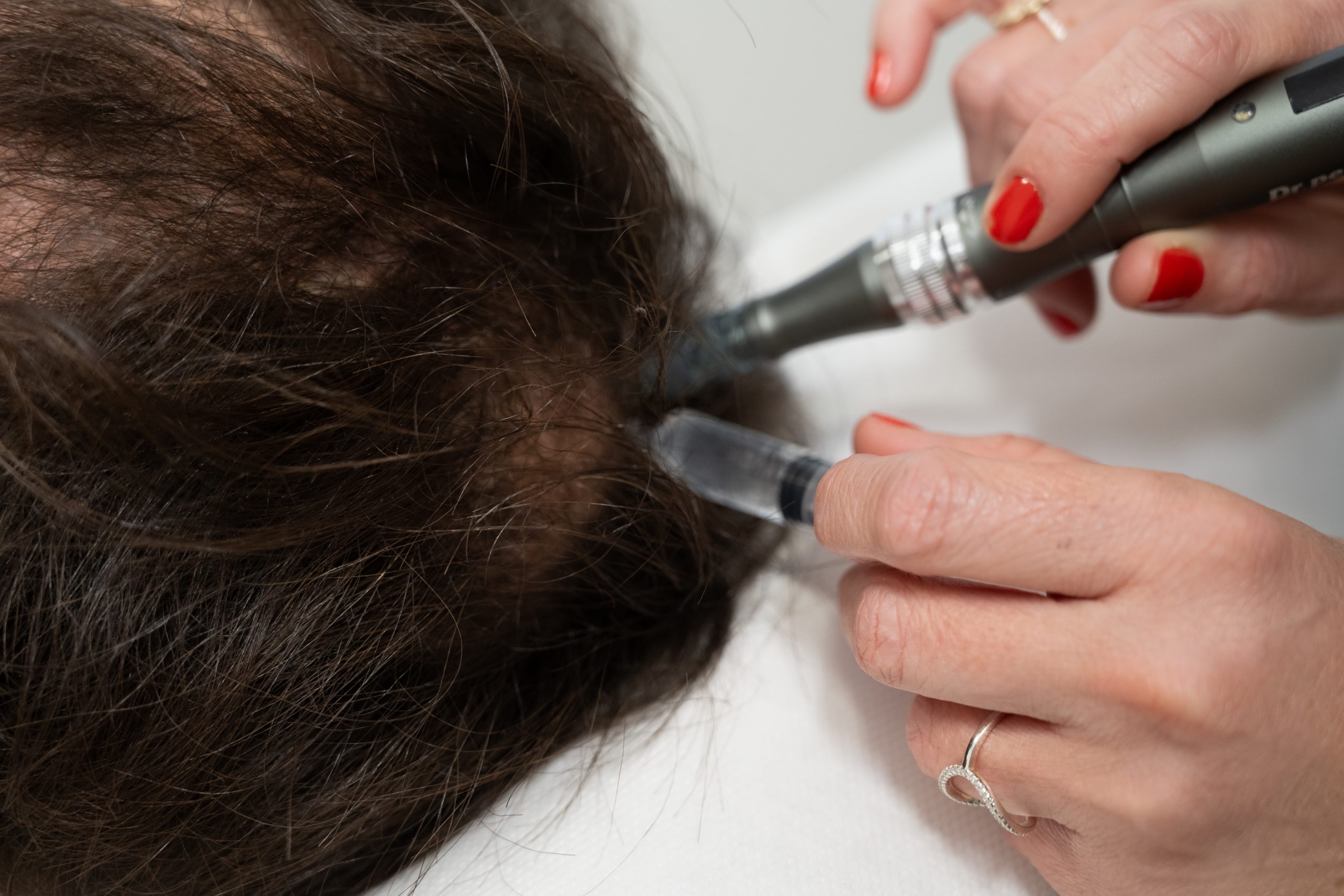 Accompagnement personnalisé de la chute de cheveux