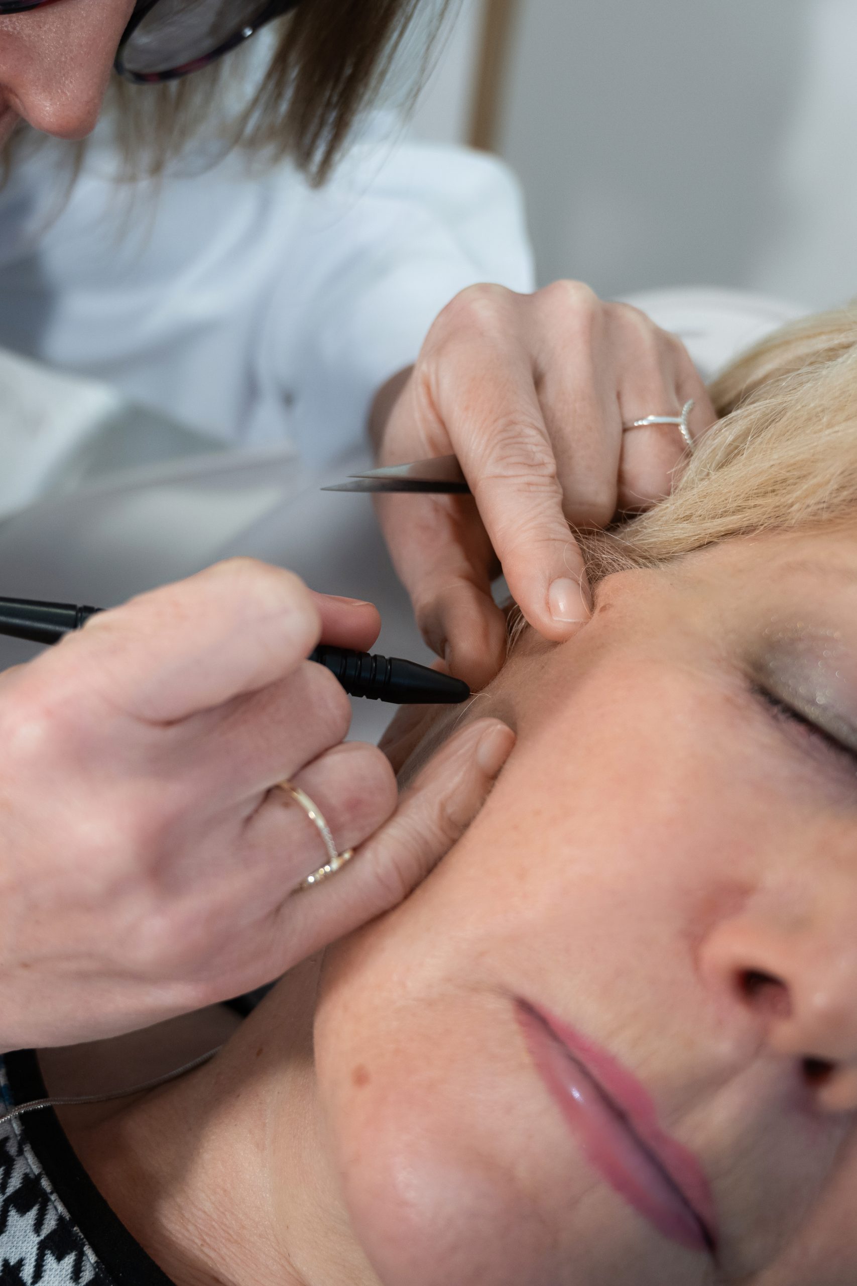 Diagnostic personnalisé avant épilation laser ou électrolyse